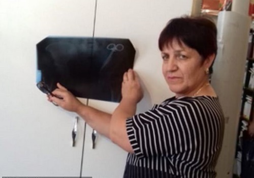 Bà Ezeta Gobeeva cùng hình ảnh phim chụp X-quang khoang bụng của mình