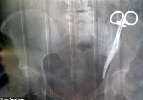 Hình ảnh X-quang chiếc kẹp phẫu thuật bị bỏ quên trong khoang bụng của bà Gobeeva