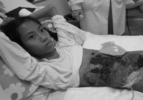 Cô bé dùng vải che nội tạng được bác sĩ mổ xuyên đêm đã đỗ Đại học Y Hà Nội