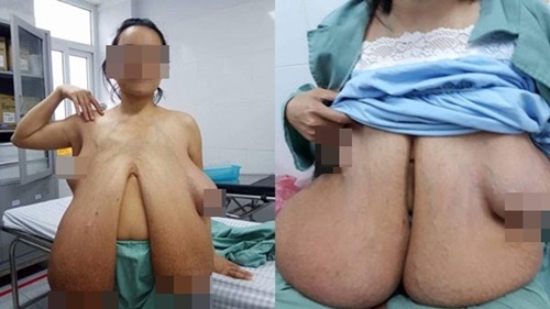 Giật mình trước bộ ngực “khổng lồ” của phụ nữ Việt 31 tuổi