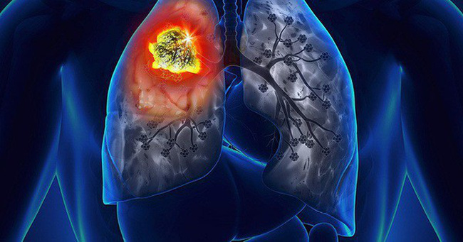 Chuyên gia hướng dẫn cách nhận biết bệnh ung thư phổi từ sớm