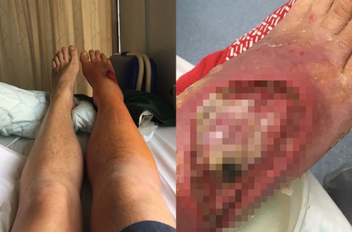 Kỳ lạ: Nam bệnh nhân hồi sinh nhờ….400 con giòi ăn vết thương ở chân