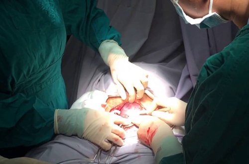 Bác sĩ 30 năm tay nghề ngỡ ngàng khi đỡ đẻ cho trẻ sơ sinh khổng lồ