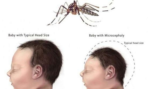 Virus Zika gây tật đầu nhỏ ở trẻ nguy hiểm ra sao và phòng bệnh thế nào?
